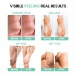 Exfoliating Foot Peeling Mask for Dry, Cracked Heels & Calluses With Glycolic, Lactic & Salicylic Acid | Peels Dead Skin in Days | Baby Soft Feet Treatment for Men & Women (1 Pair) - Image 5