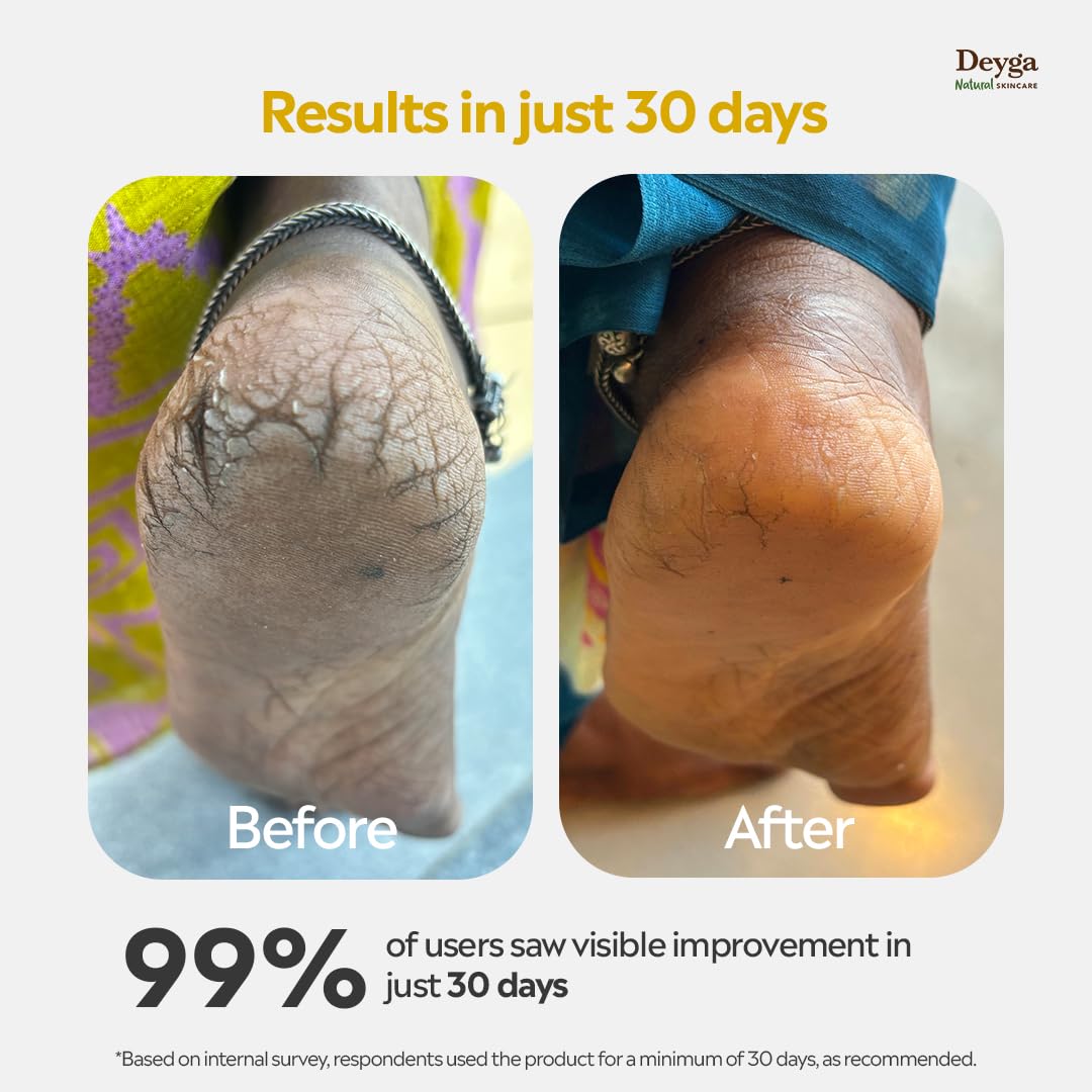 Deyga Foot Cream Trial Pack | For Dry And Cracked Feet | Moisturizes Rough Heels | Suitable For All Skin Types| Foot Butter For Men & Women| Prevents Wrinkles (10 Gram - Trial Pack) - Image 3