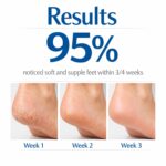 20% Urea Foot Cream Roll On 50ml | For Dry & Cracked Heels | With 5% Lactic Acid, Olive Oil & Vitamin E | Helps Repair and Moisturise Cracked Heels - Image 6