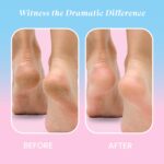 Urban Yog Callus Remover, Foot Scrubber For Dead Skin, With 3 Interchangeable Head Rollers, Rechargeable, Callus & Dead Skin Removal, 2 Speed Settings, Fast Type-C Charging, 1200mAh Battery - Image 3